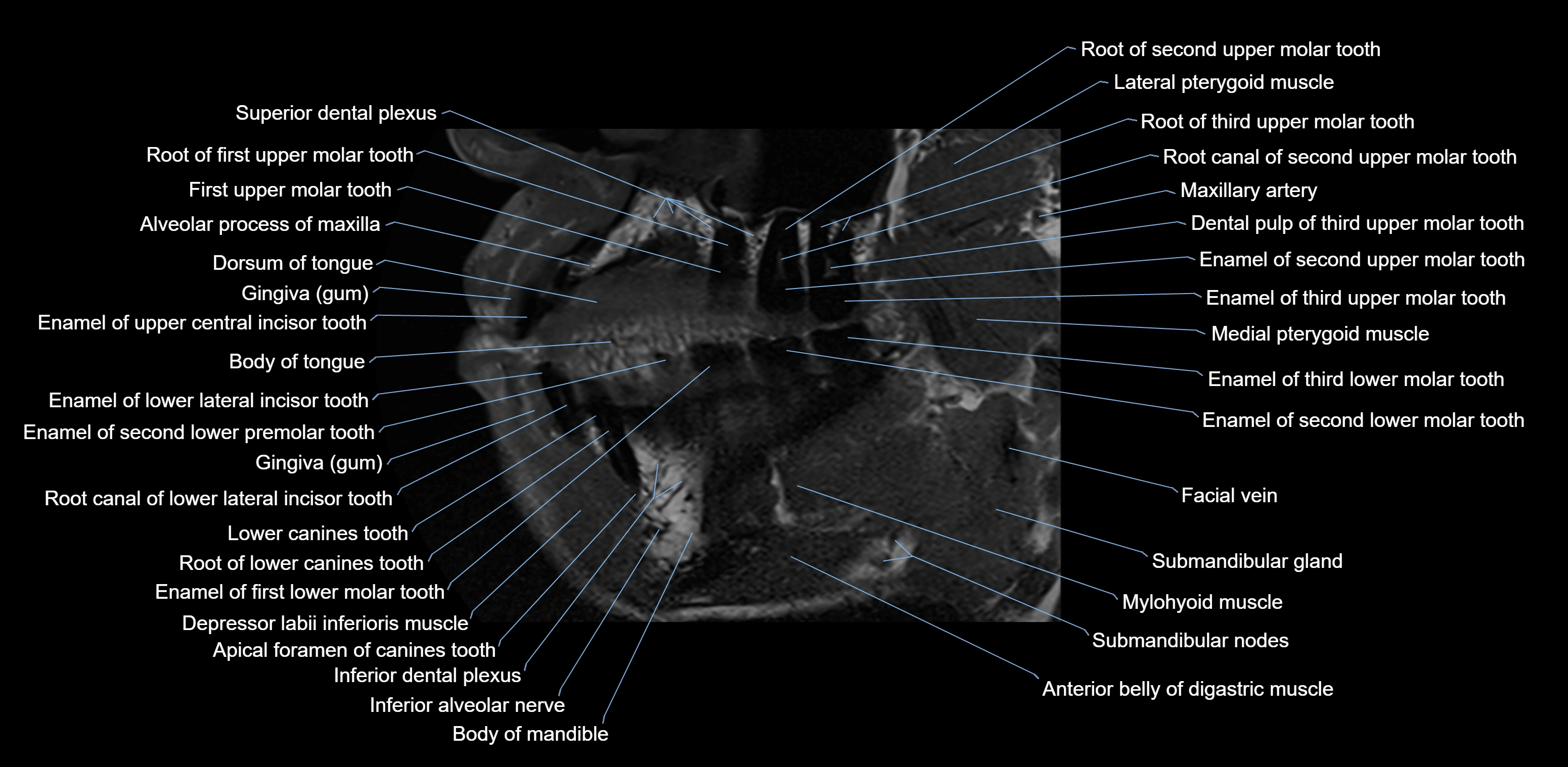 Dental MRI( tooth) sagittal labelled  cross sectional 3T anatomy -img-00001-00009.webp